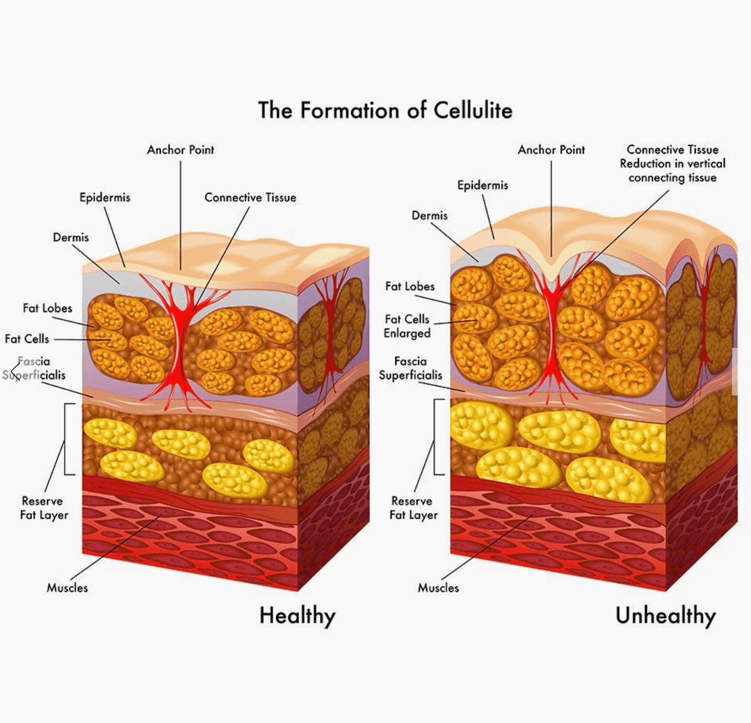 Cellulite Reduction Fascial Release Tool